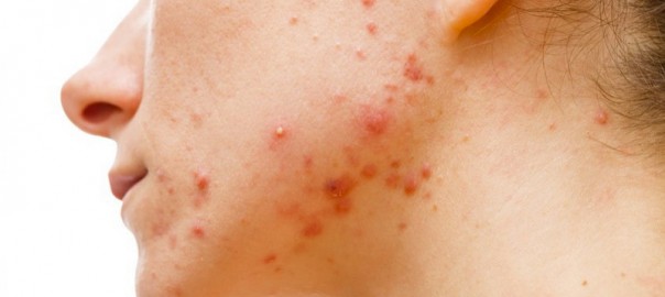 anti acne
