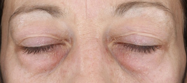 Reduction of Under-Eye Bags